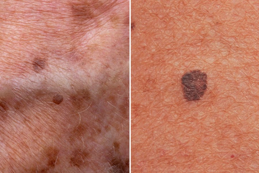 Age spots video presentation