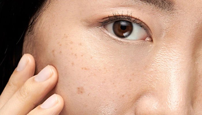 Brown spots video presentation