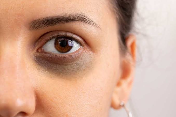 Dark circles under eyes video presentation