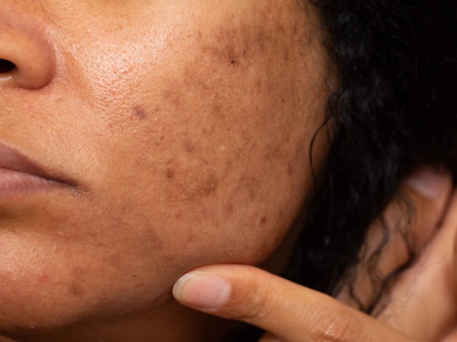Dark spots video presentation