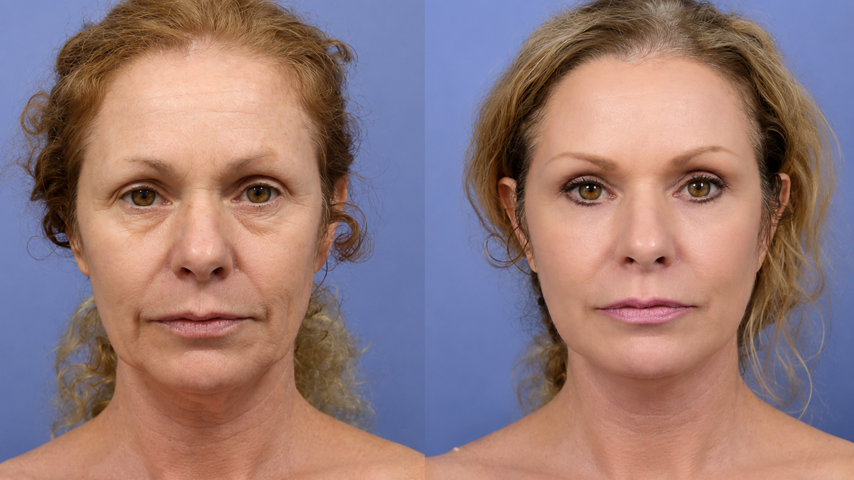 Before and after wrinkle vanishing ritual results